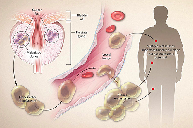 Metastatic Prostate Cancer: What You Need To Know